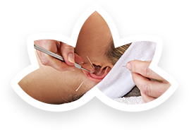 Auriculoterapia